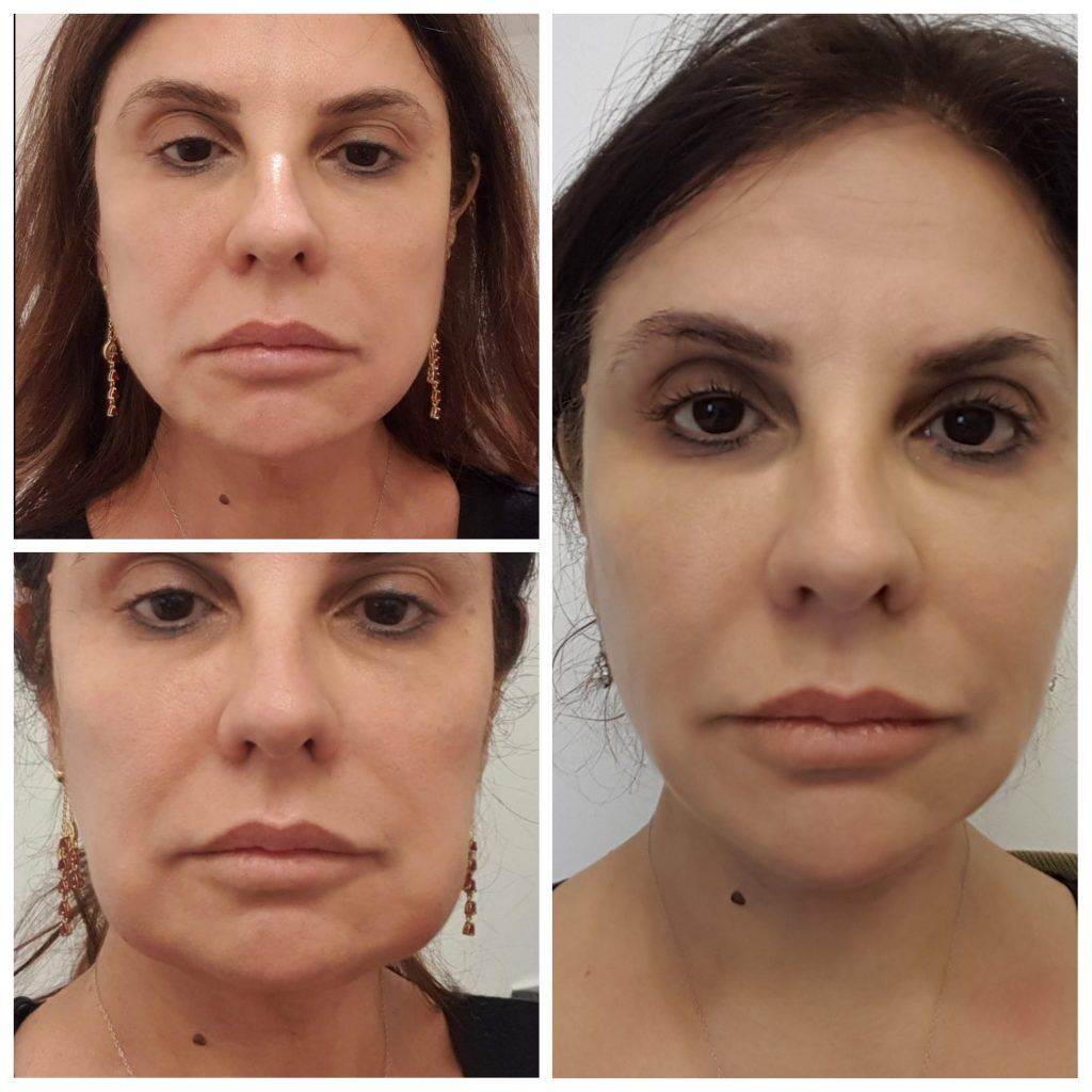 Non Surgical Jowl Lift Treatment Near Me London, Hurghada, Cairo Egypt