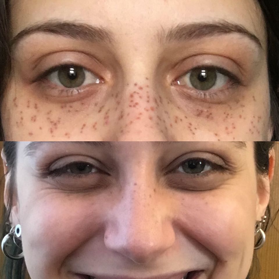 Tattooed Freckle Removal - Free Video Consultation